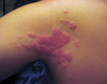 Coral rash caused by brushing up against 'fire coral'.